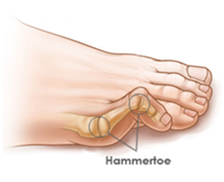 Hammertoe causing bent toe and discomfort—treated by our Canton, MI podiatrist with nonsurgical and surgical solutions.