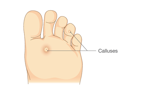 Close-up of calluses on foot treated by a podiatrist in Canton, MI