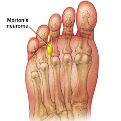 Foot diagram showing Morton’s neuroma between third and fourth toes, treated by podiatrist in Canton, MI