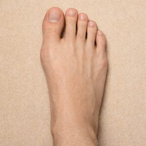Forefoot surgery for bunions, hammertoes, and metatarsal pain performed by podiatrist in Canton, MI