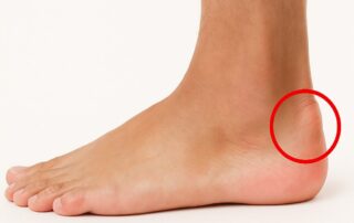 an image of the back of a heel showing the bony bump characteristic of Haglund’s deformity, with mild redness and swelling around the Achilles area.