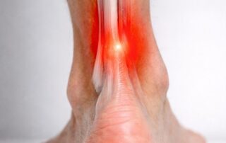 Inflamed Achilles tendon causing pain and redness at the back of the heel