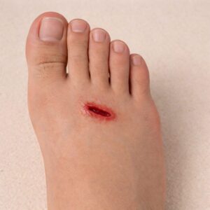 Close-up of a painful open wound on the top of a foot with redness and irritation.