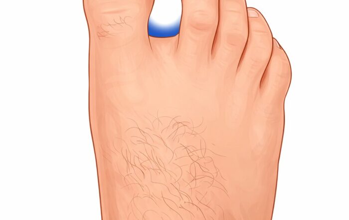 adult foot showing a gap between the big toe and second toe