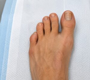 Crossover toe with toes drifting