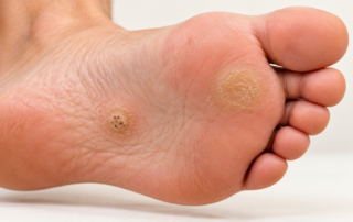 Plantar wart and callus on the bottom of a foot showing differences in skin appearance